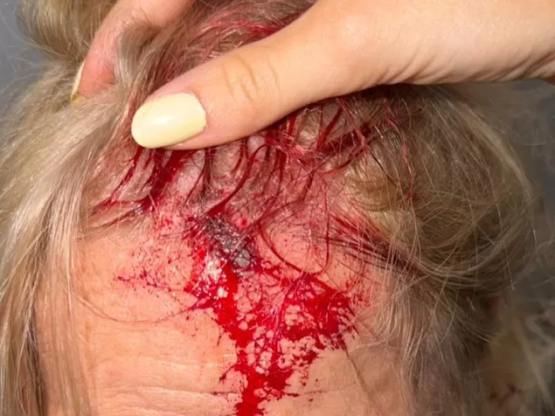 Brutal ataque en City Bell: Una mujer termino con la cabeza abierta tras ser golpeada salvajemente con un palo de amasar