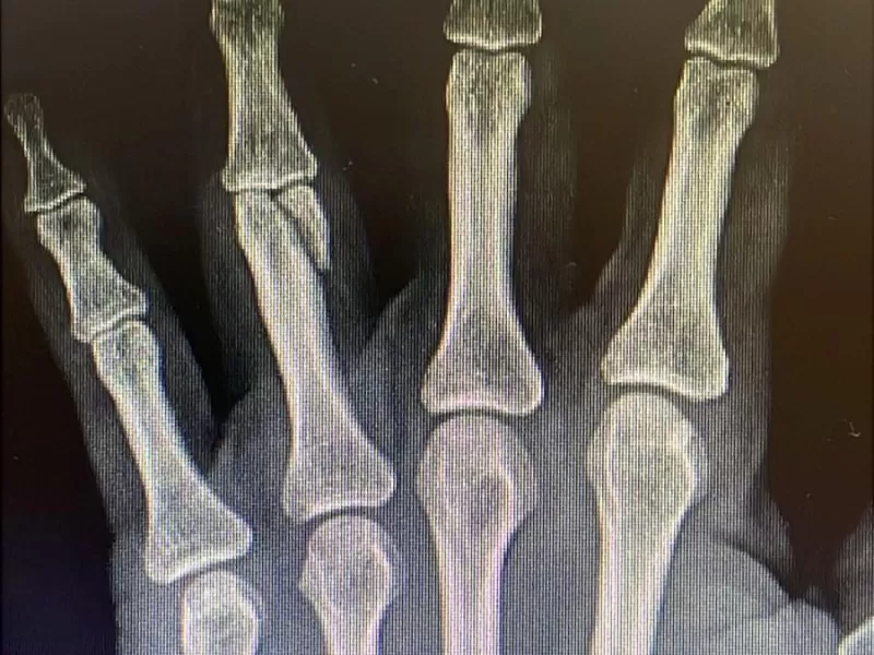 Brutal ataque en City Bell: Una mujer termino con la cabeza abierta tras ser golpeada salvajemente con un palo de amasar